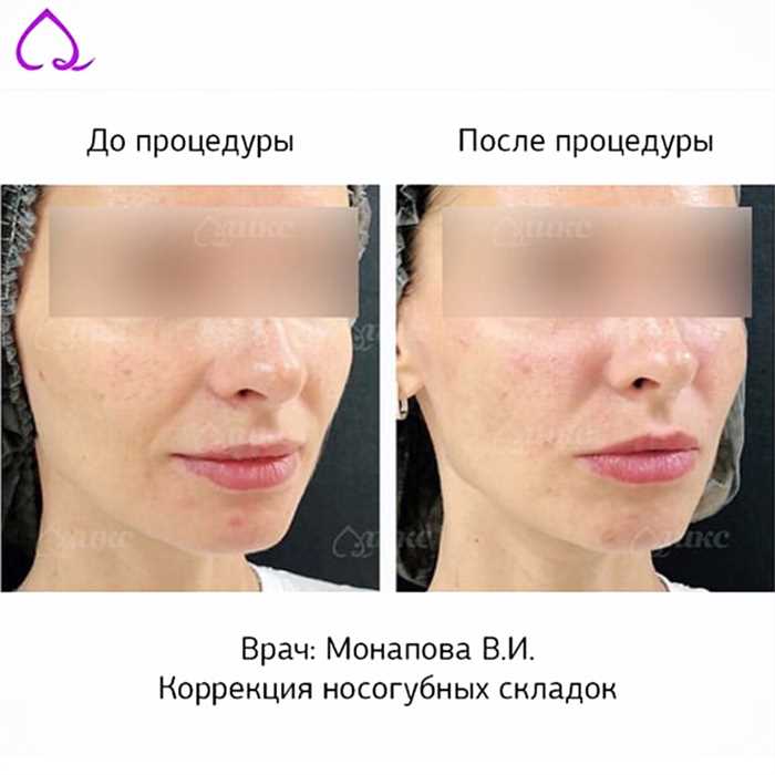 Коррекция носогубных складок без инъекций: эффективное применение филлеров