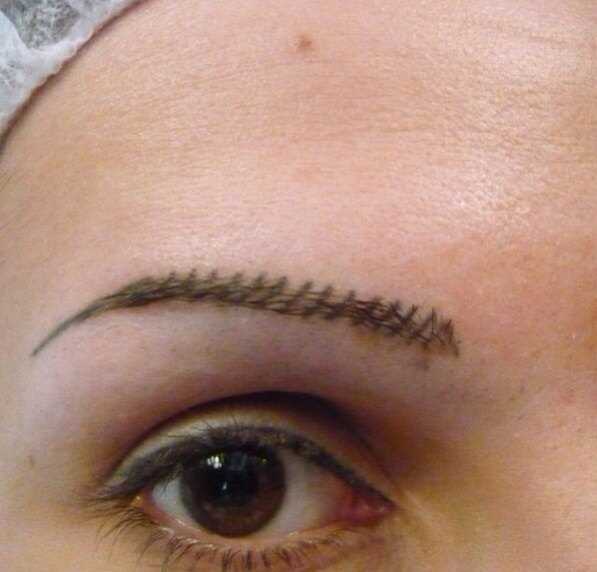 Последствия неудачного татуажа бровей